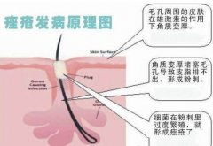 痤瘡治療的誤區(qū)有什么？痤瘡的治療要警惕哪些