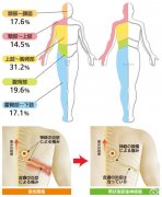 帶狀皰疹癥狀表現(xiàn)是什么樣的？